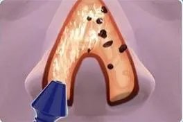 洗鼻器原理流经图