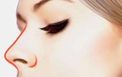 做膨体隆鼻效果好不好