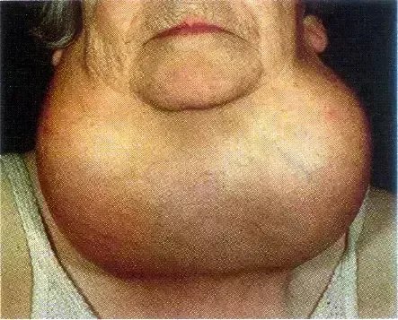 海带当饭吃会得甲亢？那也得看你能吃多少！