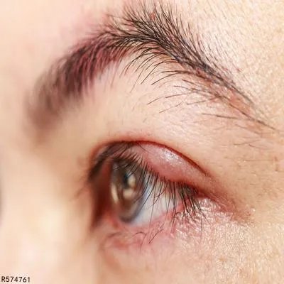 吸脂去眼袋手术的注意事项有哪些