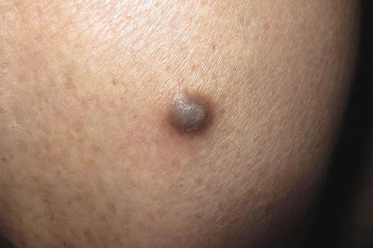 屁股上长了个褐色硬疙瘩图片