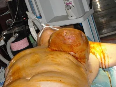 乳腺癌大包图片