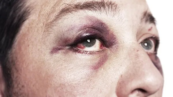 开眼角失败怎么办