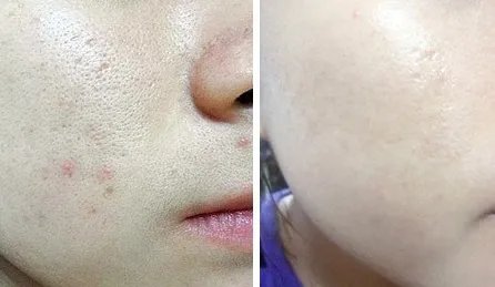 光子嫩肤和黑脸娃娃的效果