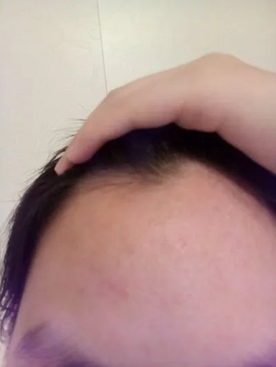 痤疮色斑的症状