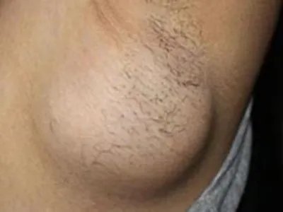 乳腺癌大包图片