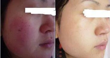 彩光嫩肤去红血丝价格高吗