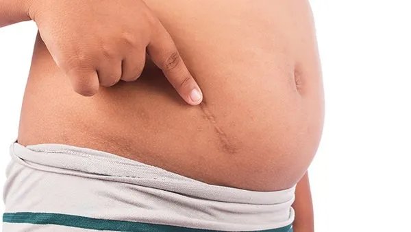 剖腹产后吃什么