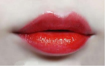 玻尿酸注射丰唇好吗