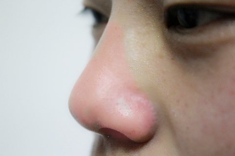 假体隆鼻能保持多久