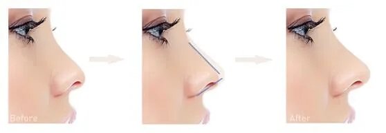 大鼻头怎么缩小