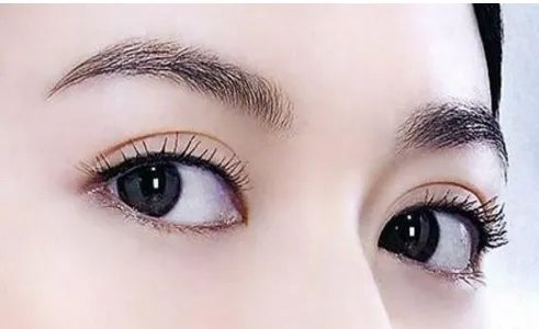 眼袋吸脂手术注意事项