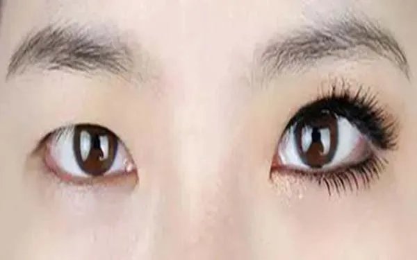 北京切开双眼皮哪个医院口碑好？