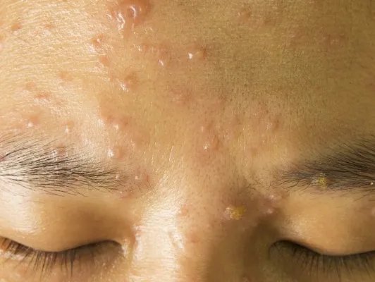 怎样保养皮肤不长痘