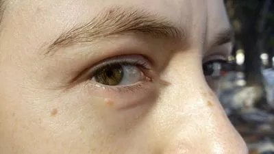 眼角的黄褐斑原因 眼角怎么会长黄褐斑呢