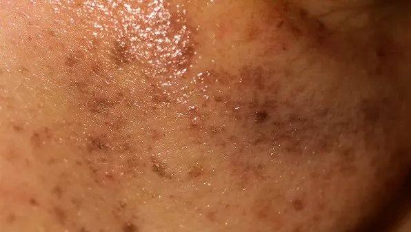 如何去除脸上色斑