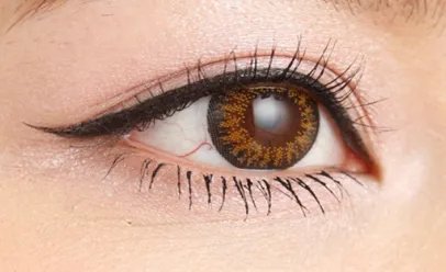 北京双眼皮手术价格