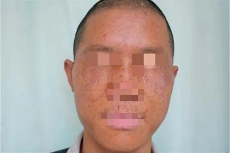 慢性移植物抗宿主病面部斑图片