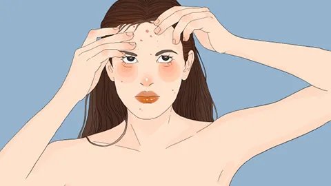 挤痘痘挤出来的是什么