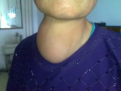 单纯性甲状腺肿颈部肿块图片