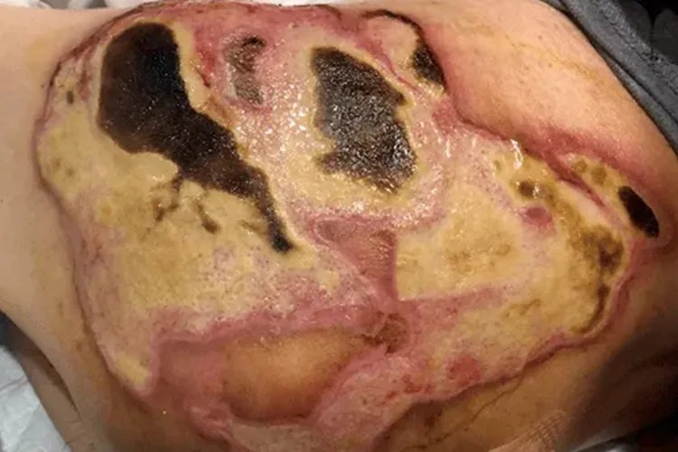 烫伤后结痂的图片是什么样子的