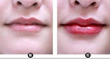 注射丰唇手术价格