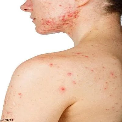 聚合性痤疮如何治疗