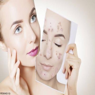 女性该如何祛痘 教你轻松祛痘5妙招