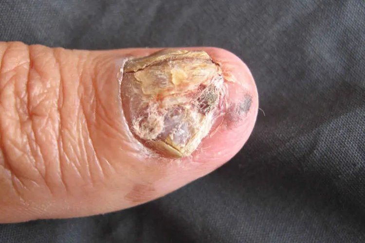 大脚拇指黑色素瘤图片