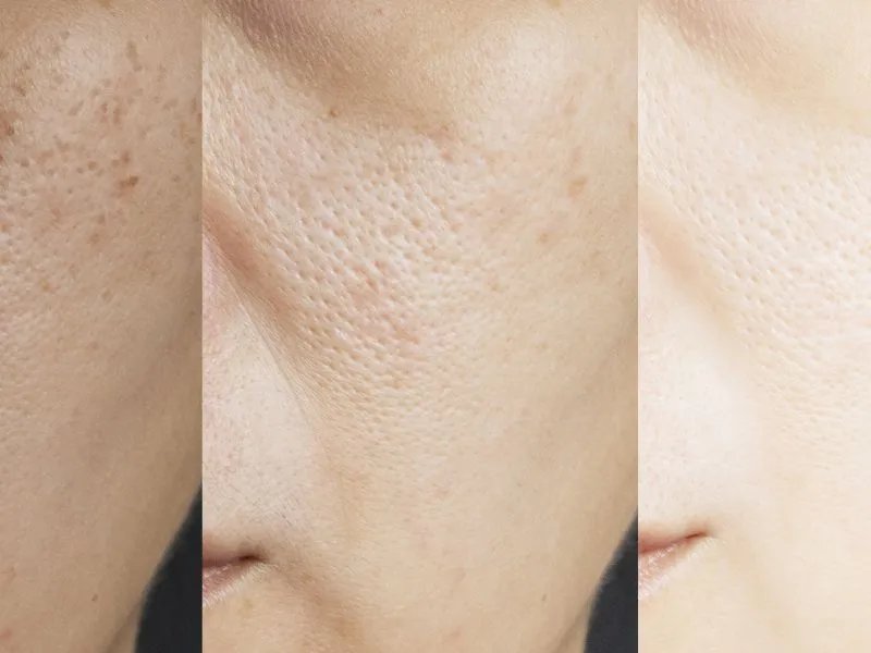 皮肤黑粗糙怎么办