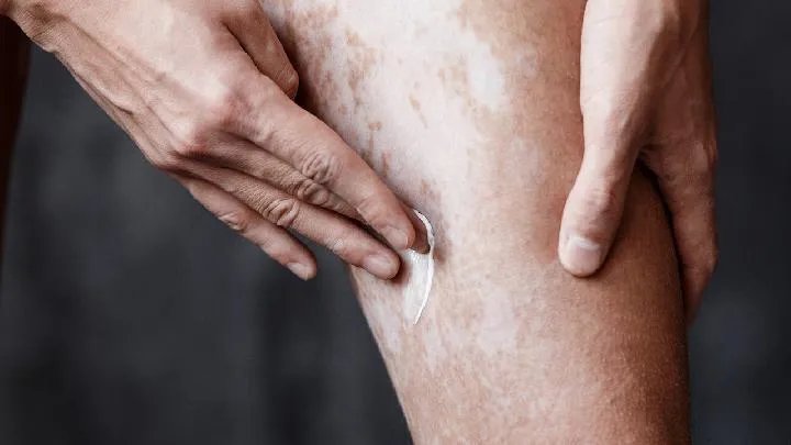 石家庄白癜风医院：得了白癜风疾病该如何做