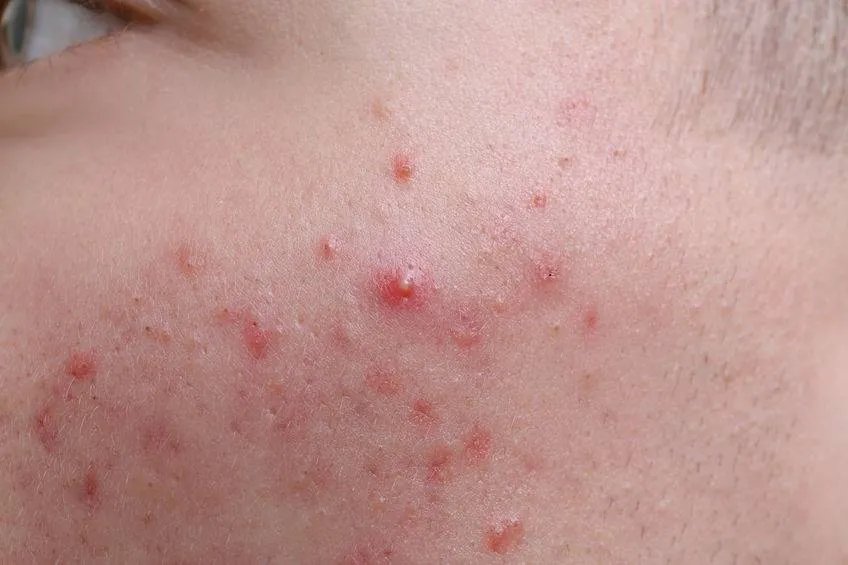 快速祛痘印的方法有哪些