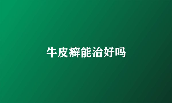 牛皮癣能治好吗