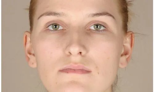 玻尿酸注射除皱过程是怎样