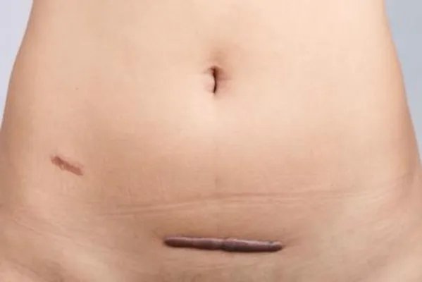 剖腹产后的疤痕注意事项有哪些