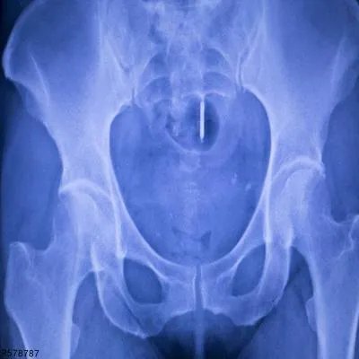 骨质增生用什么药外敷