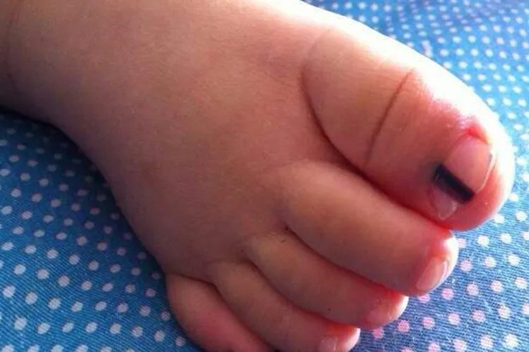 大脚拇指黑色素瘤图片