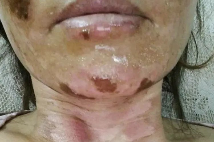 烫伤后结痂的图片是什么样子的