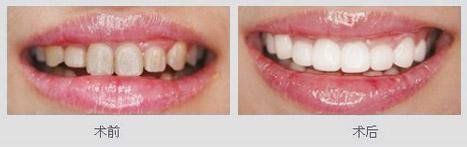 激光美白牙齿多少钱