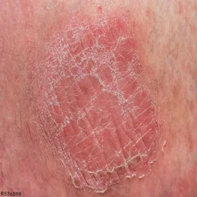 怎么能解决鸡皮疙瘩皮肤