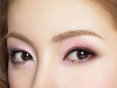 北京医院哪家做开内眼角好