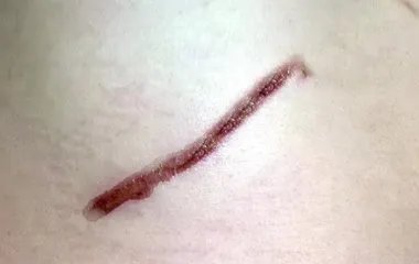 怎么有效去除陈年疤痕