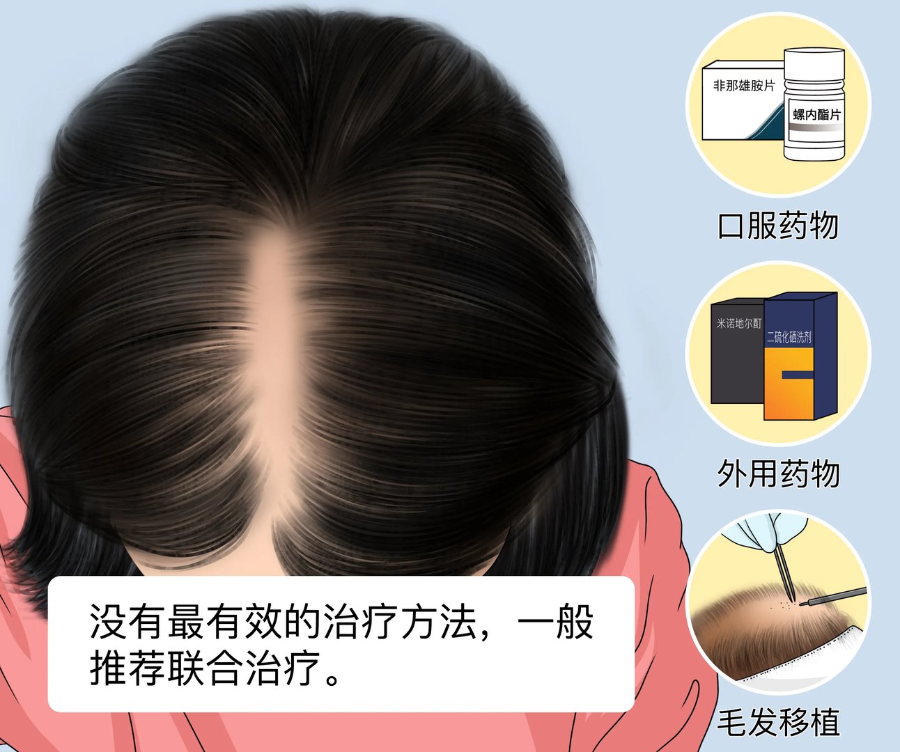 脂溢性脱发怎么治疗最有效