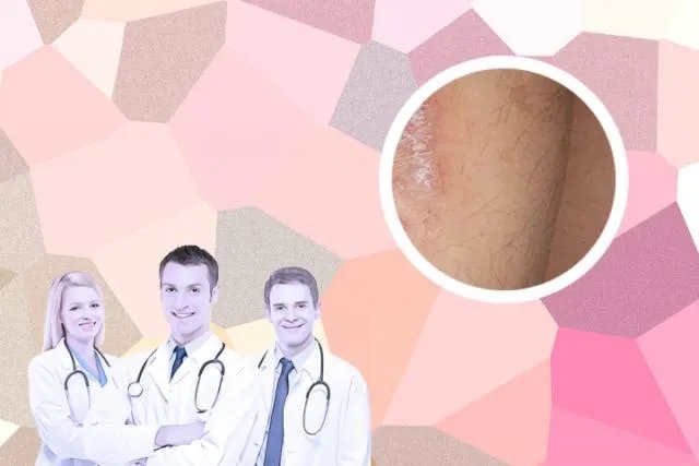 女性银屑病初期症状