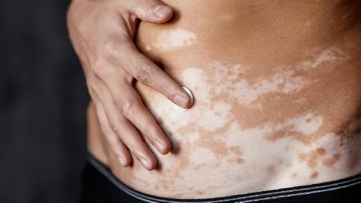 石家庄白癜风医院:得了白癜风疾病该如何做