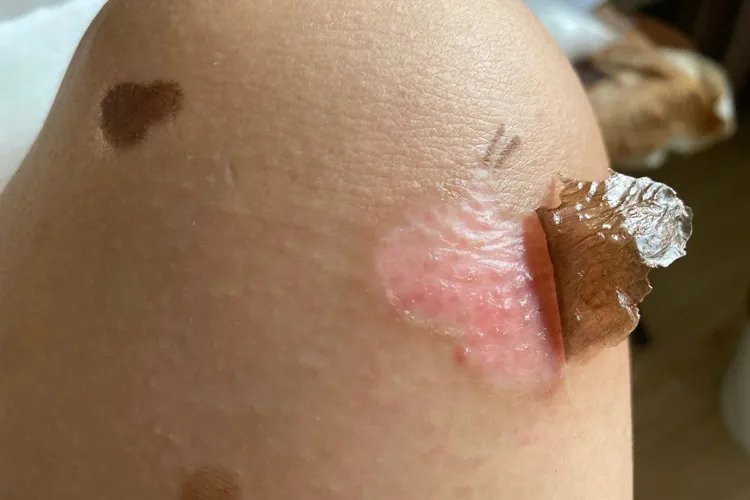 烫伤后结痂的图片是什么样子的