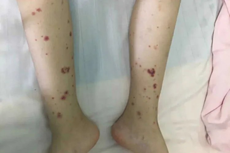 韦氏肉芽肿病小腿症状图片