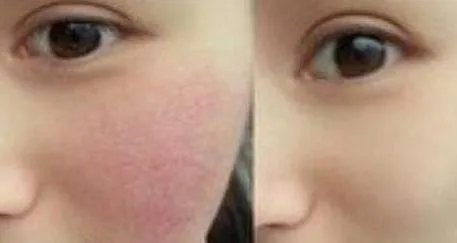 治红血丝需要多少钱