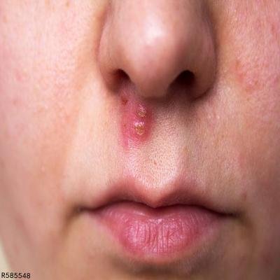 脓疱型痤疮怎么办