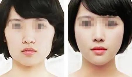 微创改脸型多少钱